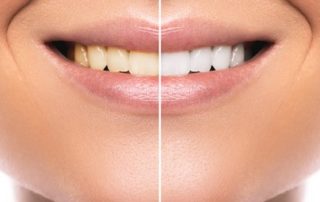 weiße oder natürliche Zähne Zahnarztpraxis Dr. Simone Gangl Ahrweiler Blog