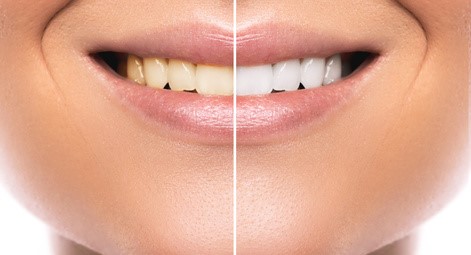 weiße oder natürliche Zähne Zahnarztpraxis Dr. Simone Gangl Ahrweiler Blog