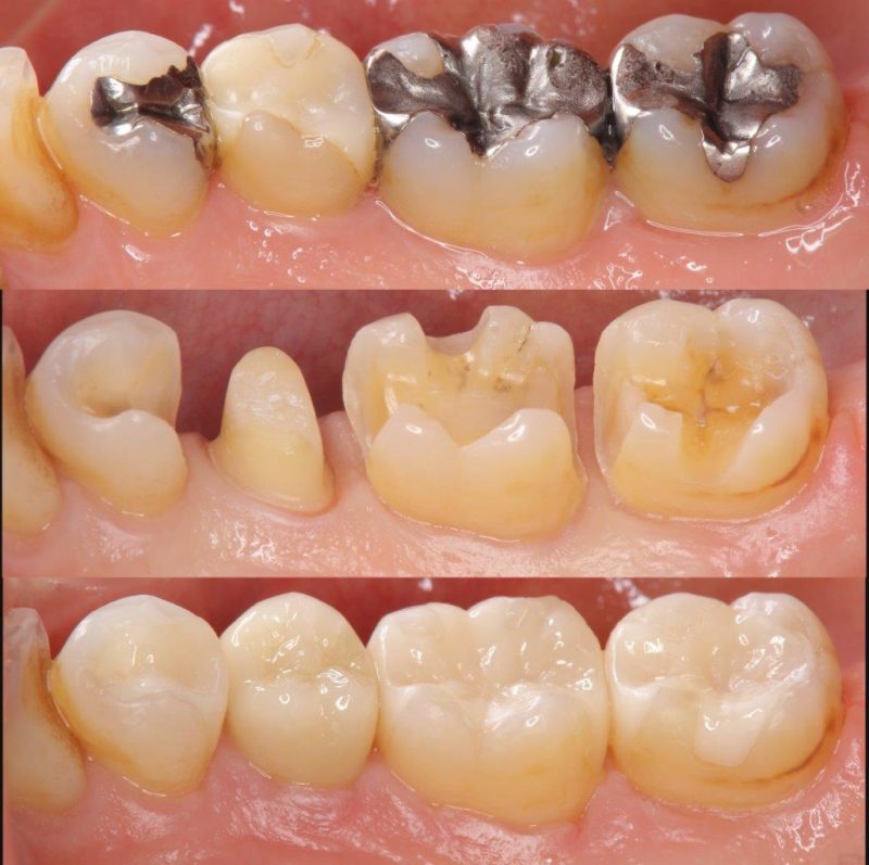 Sind Amalgam-Füllungen noch zeitgemäß? – Zahnarzt Ahrweiler – Dr ...